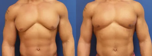 Male Breast Reduction service image