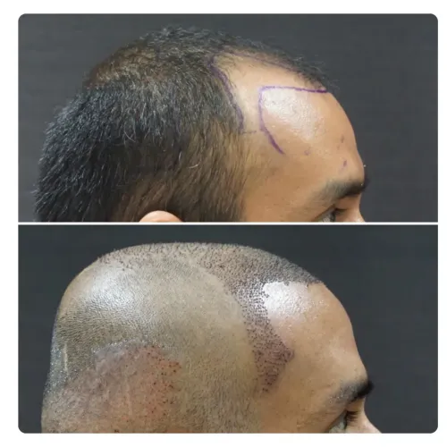 Hair Transplant service image