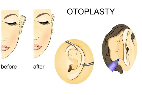 Prominent Ear Correction (Otoplasty) service image