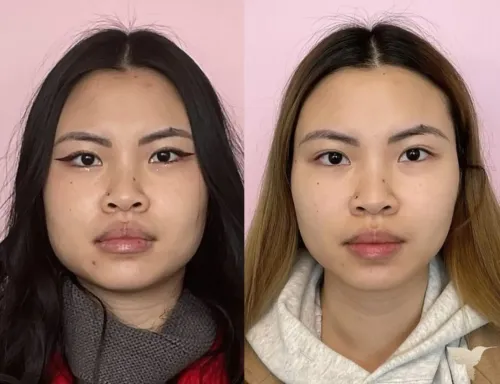 Face Slimming Surgery service image