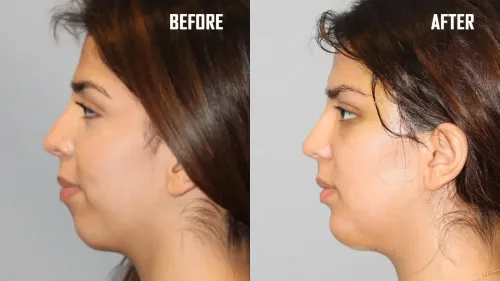 Chin Augmentation  service image