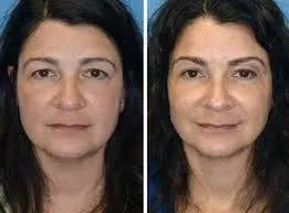 Brow Lift Surgery service image