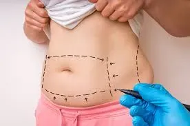 Fat Transfer Surgery service image