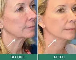 Neck Lift Surgery service image