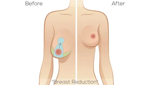 Breast Reduction Surgery service image