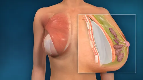 Breast Augmentation service image