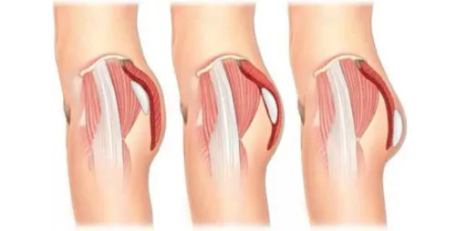 Buttock Augmentation service image