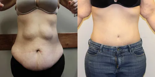 Tummy Tuck (Abdominoplasty) service image