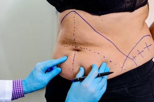 Liposuction  service image