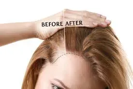 Hair Fall Treatment service image