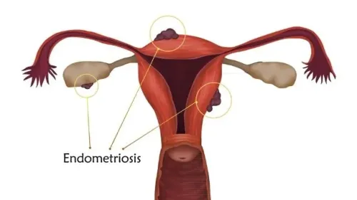 Endometriosis Treatment  service image