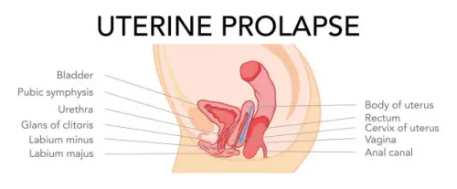 Prolapse Uterus service image