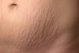 stretch marks treatment service image