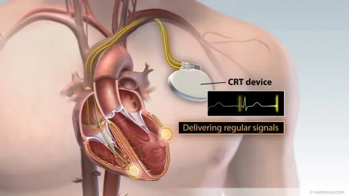 Pacemaker / ICD / CRT Implantation service image
