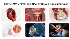 Structural Heart Procedures – TAVI, MitraClip & TriClip service image