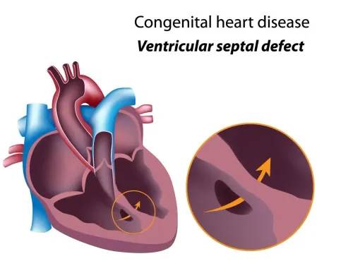 Congenital Heart Disease Treatment service image