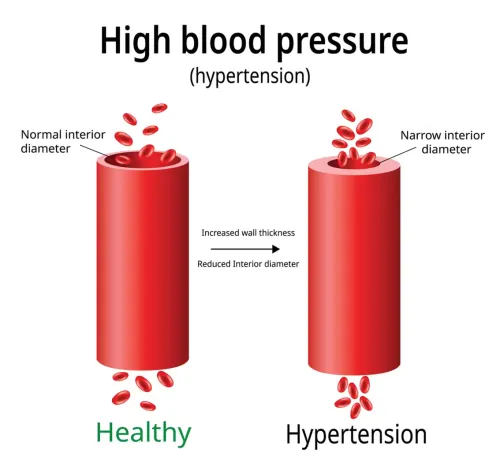 High Blood Pressure (Hypertension) Treatment service image