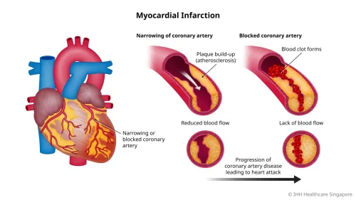 Heart Attack (Myocardial Infarction) treatment service image