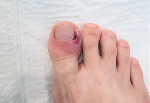Toe pain / Abscess service image