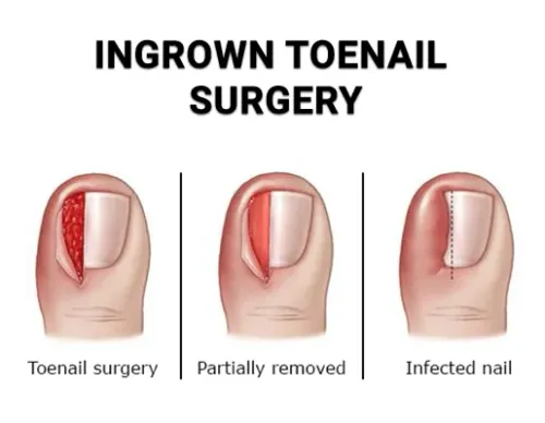 Ingrown toenail removal service image