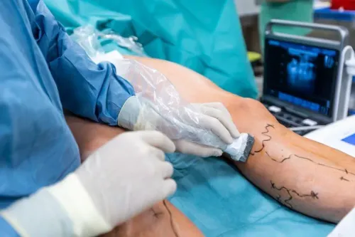 varicose vein surgery service image