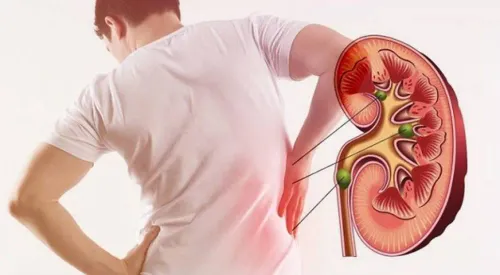  Kidney Stones service image