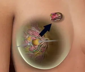 Lump Excision service image