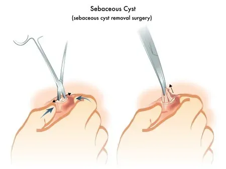 Cyst Excision surgery service image