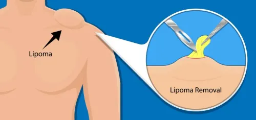 Lipoma Excision Surgery service image