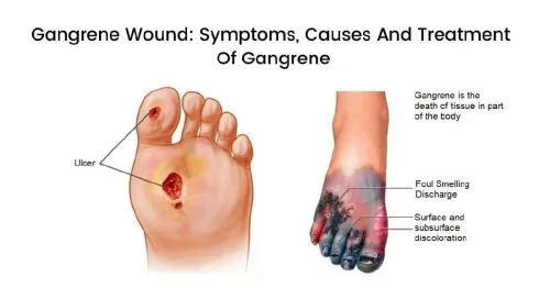 Gangrene Surgery service image