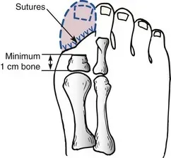 Toe Amputations service image
