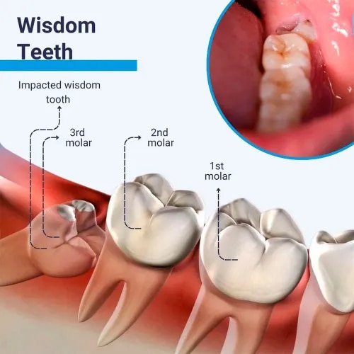Wisdom Tooth Extraction product image