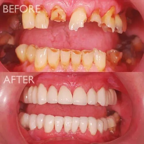 Full Mouth Rehabilitation product image