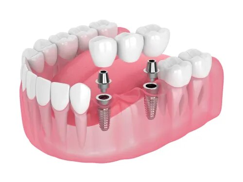 Crowns & Bridges product image