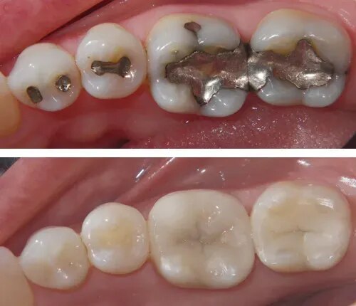 Tooth-Colored Fillings & Restorations product image