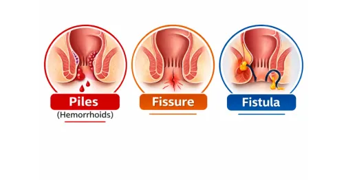 OPD for Piles / Fissure / Fistula service image