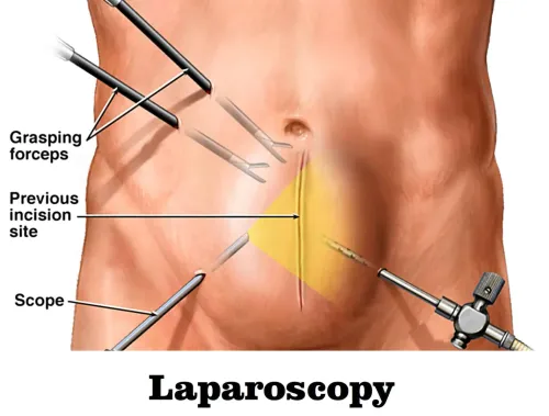 Laparoscopic Hernia repair service image