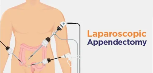 Laparoscopic Appendectomy service image