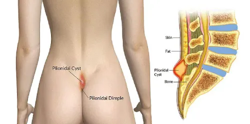 Laser Pilonidal sinus service image