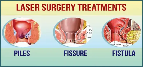 Laser Fistula service image