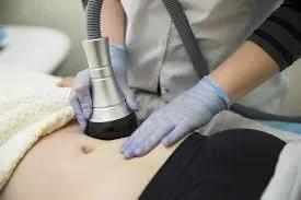 Laser Lipolysis service image