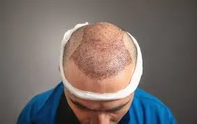 Hair Transplant  service image