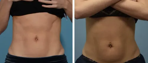 Body sculpting surgery service image