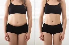 Laser Liposuction service image