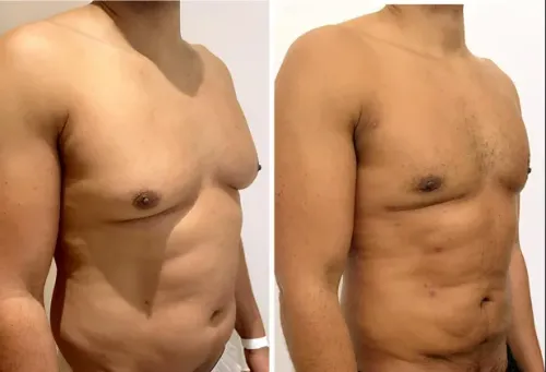 Gynaecomastia correction Abdominoplasty service image