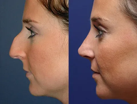Rhinoplasty service image