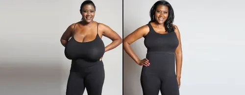 Breast Reduction Surgery service image