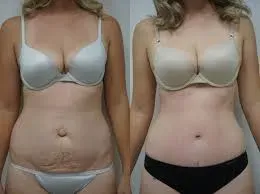 Tummy tuck surgery  service image