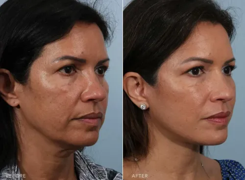 Face Lift Surgery service image