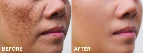 Melasma/ Hyperpigmentation Treatments service image